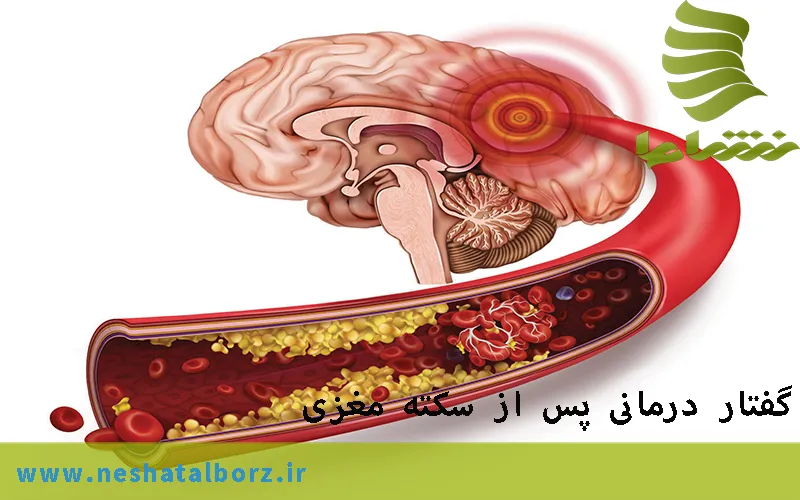 گفتار درمانی پس از سکته مغزی