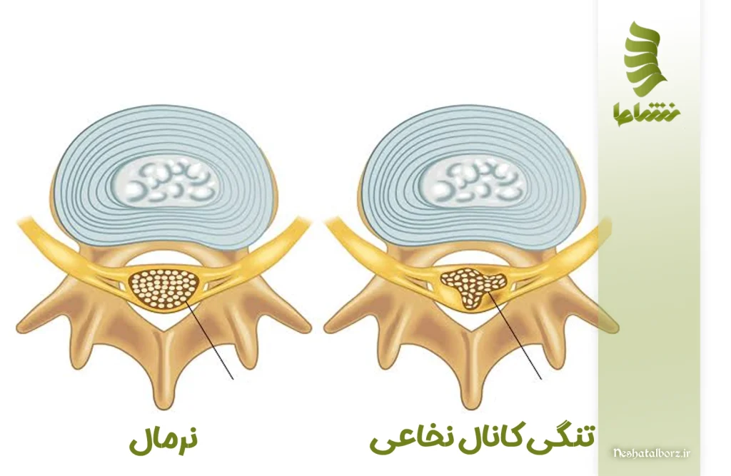 تنگی کانال نخاعی چیست؟