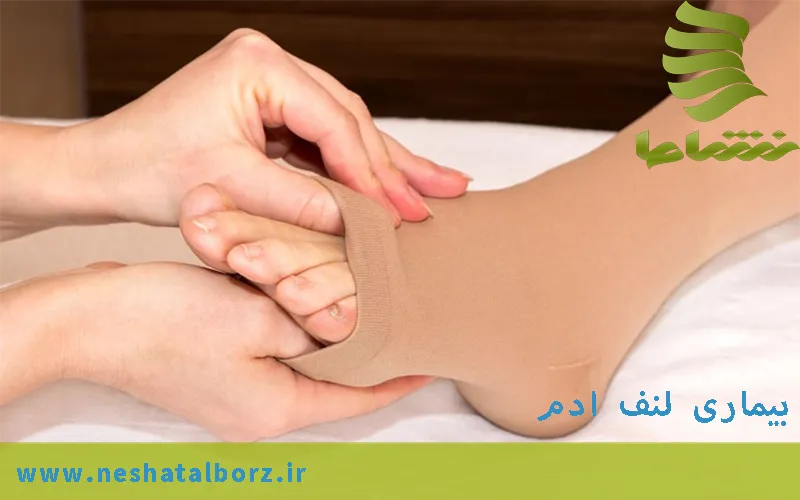 لنف ادم و روش های درمانی - فردیس کرج