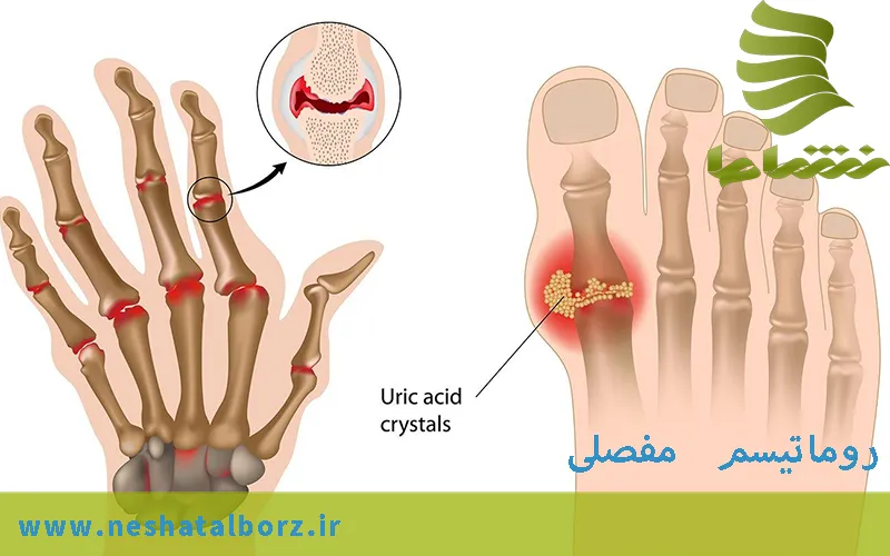 روماتیسم مفصلی (Rheumatoid arthritis)
