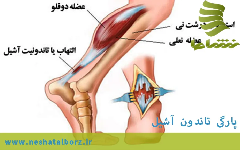پارگی تاندون آشیل