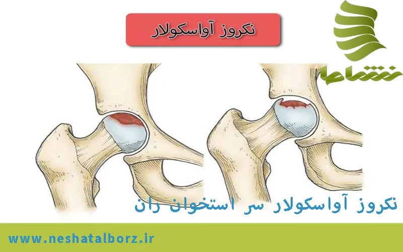 نکروز آواسکولار سر استخوان ران