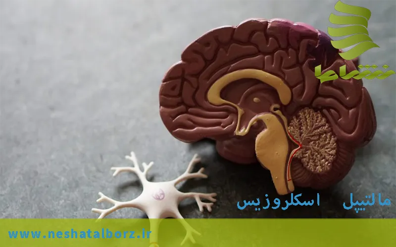 مالتیپل اسکلروزیس یا MS روش های درمانی