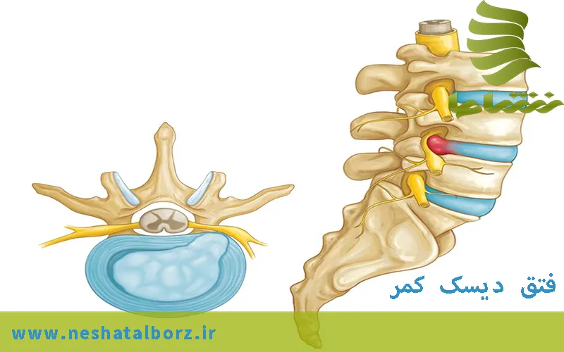 فتق دیسک کمر (Herniated disk) روش های درمانی