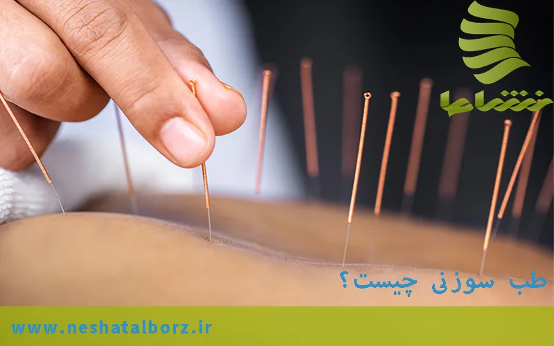 طب سوزنی