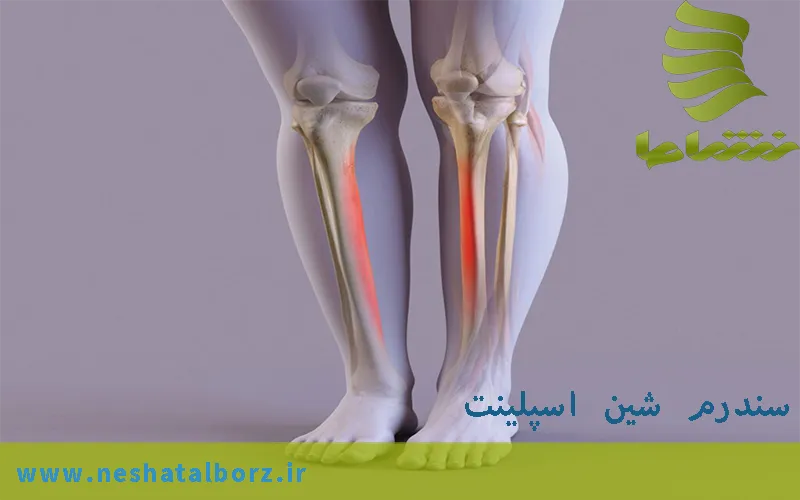 سندرم شین اسپلینت