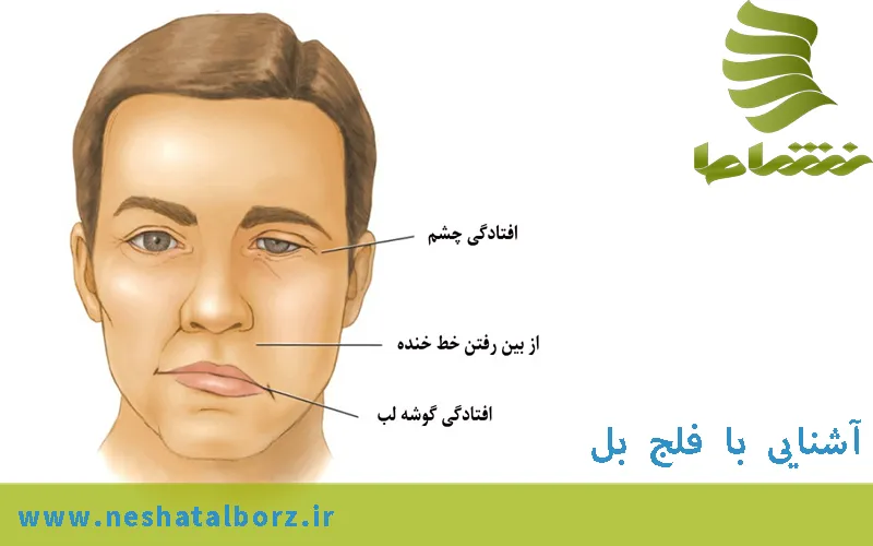 فلج بل و روش های درمانی آن
