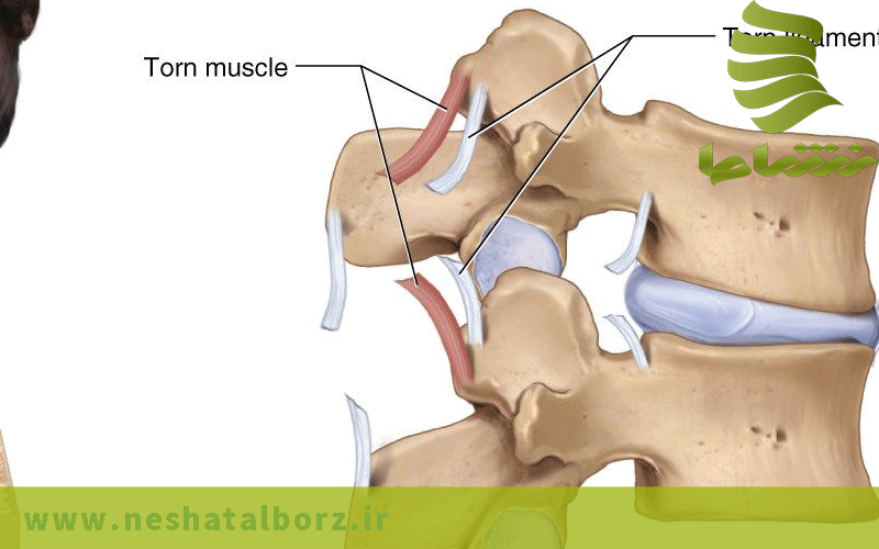 کشیدگی عضلات و تاندون ها در ناحیه کمر