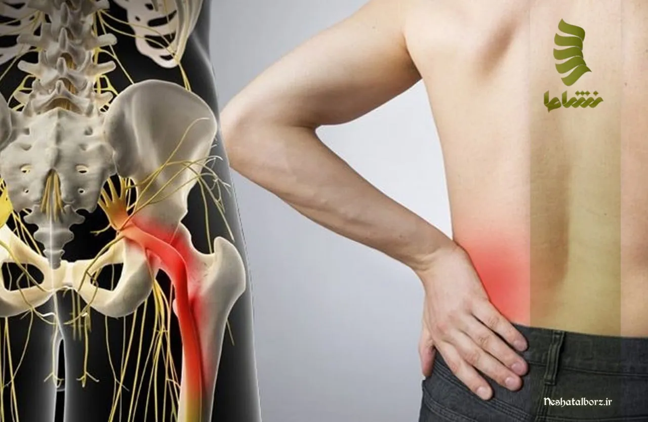 راهکارهای موثر در درمان سیاتیک و بهبود کیفیت زندگی