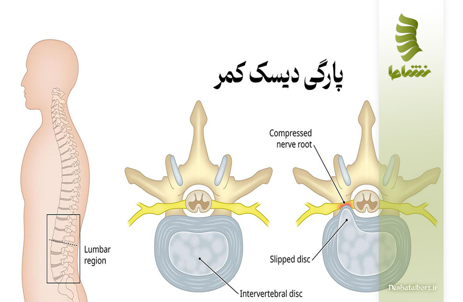 پارگی دیسک کمر (رِپِشِد دیسک) چه تفاوتی با بیرون زدگی دیسک کمر (هترنیشن) دارد؟