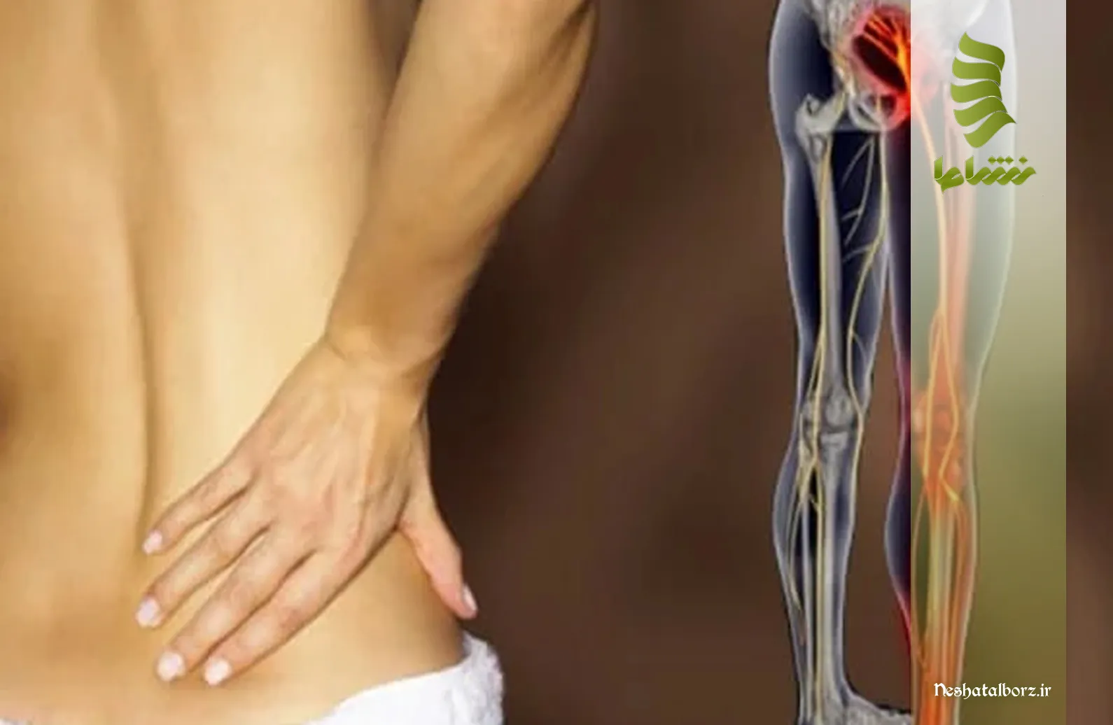 مقایسه دو بیماری شایع ستون فقرات، یعنی دیسک کمر و سیاتیک