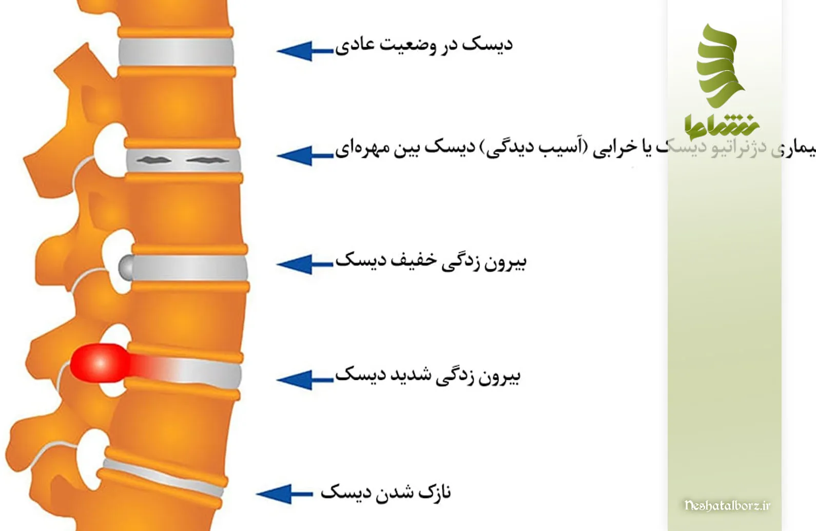 بررسی علل، علائم و درمان پارگی دیسک بین مهره­ای کمر