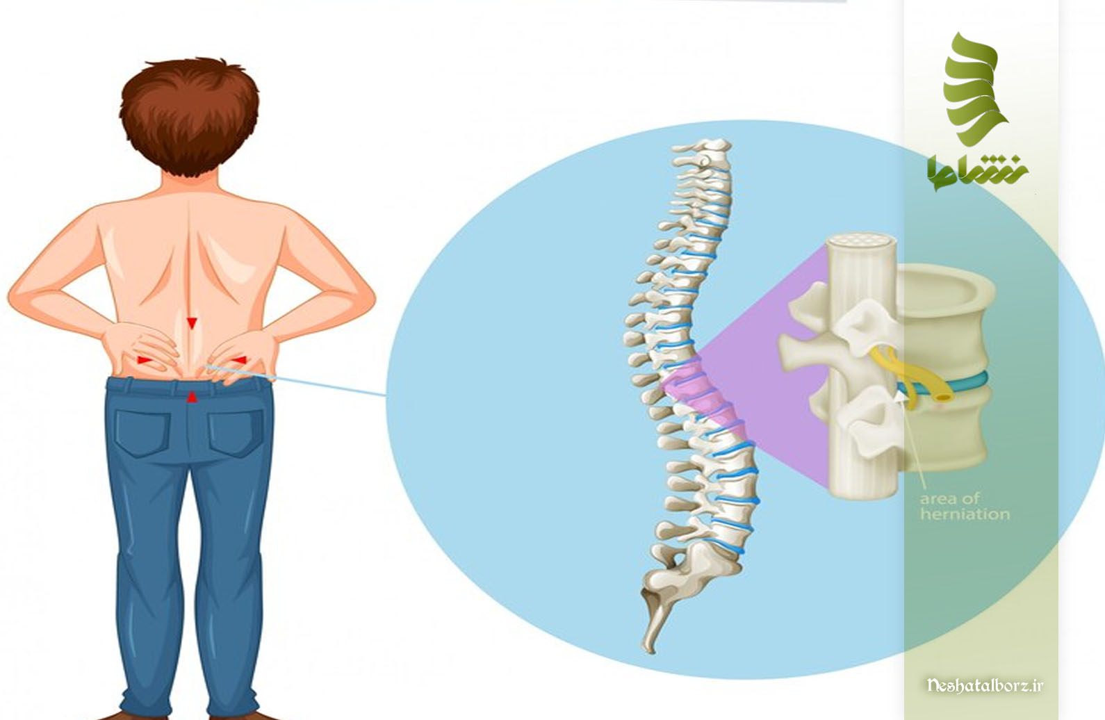 تفاوت پارگی دیسک با بیرون زدگی دیسک