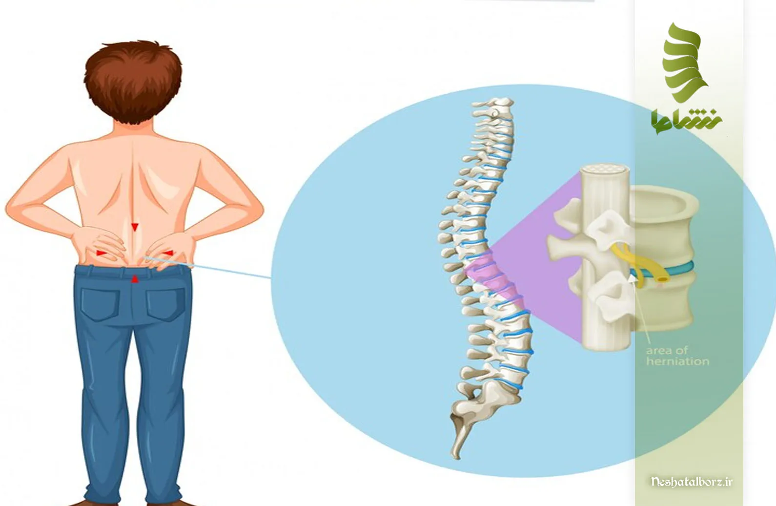 تفاوت چسبندگی با بیرون زدگی و پارگی دیسک کمر چیست؟