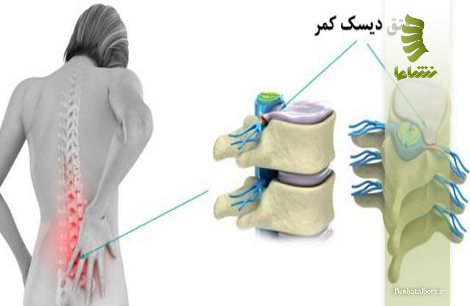 چگونه بفهمیم که دچار فتق دیسک کمر شده‌ایم؟