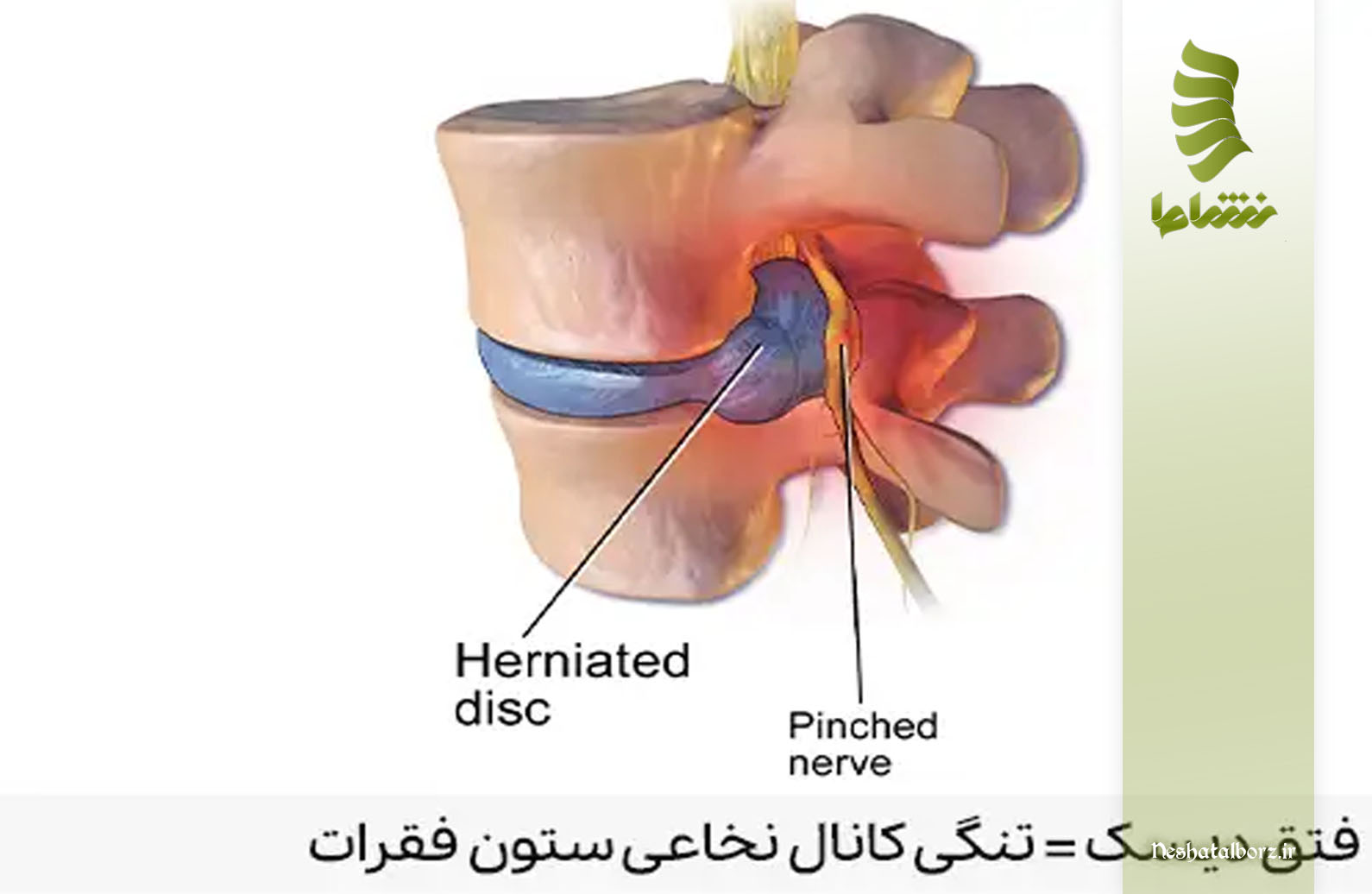 نتیجه ­گیری در مورد فتق دیسک کمر