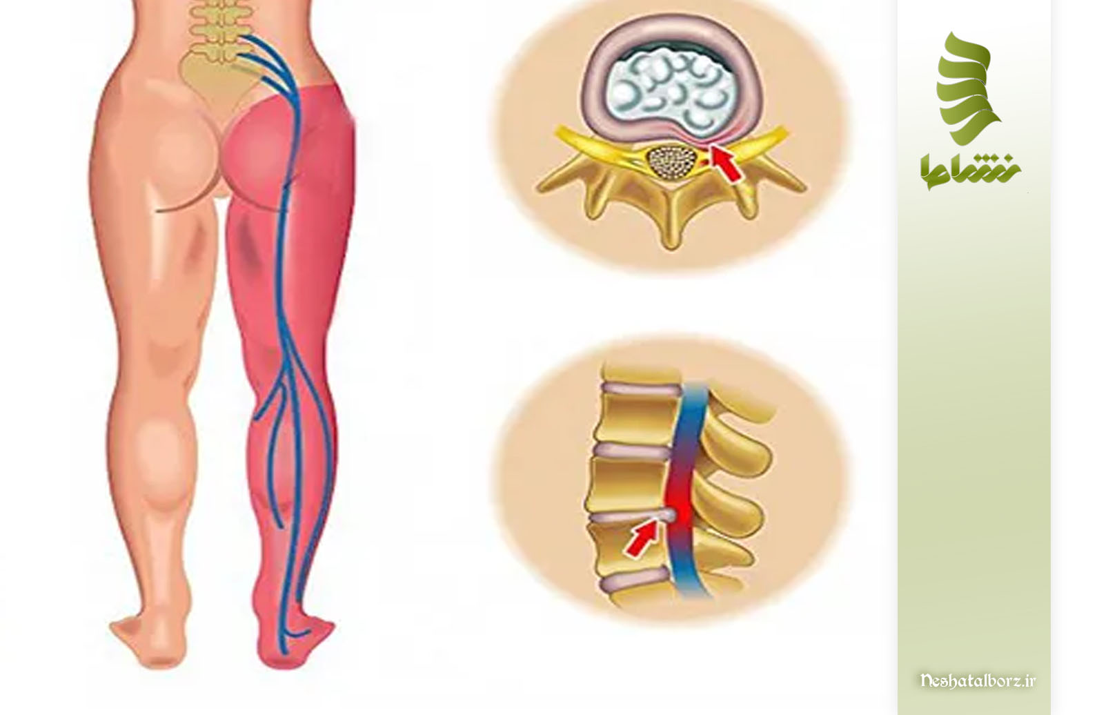 علائم عصبی مرتبط با فتق دیسک کمر