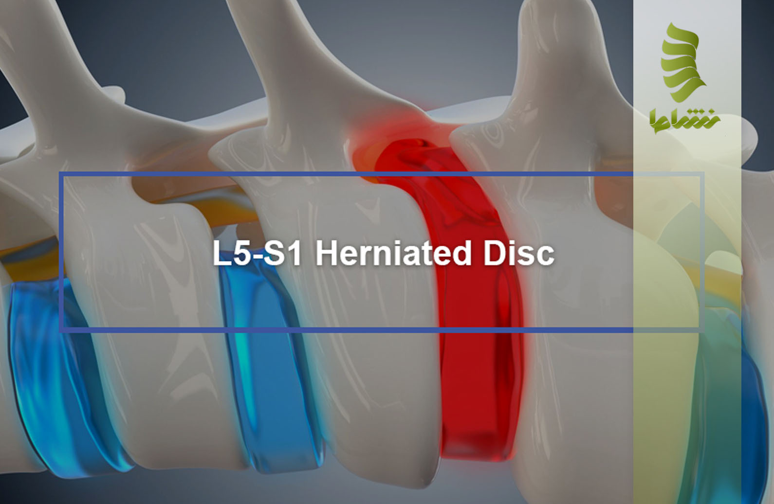 درمان بیرون زدگی دیسک L5-S1