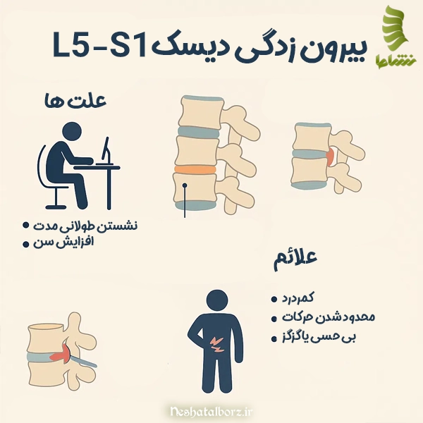 علائم و علت بیرون زدگی دیسک L5-S1
