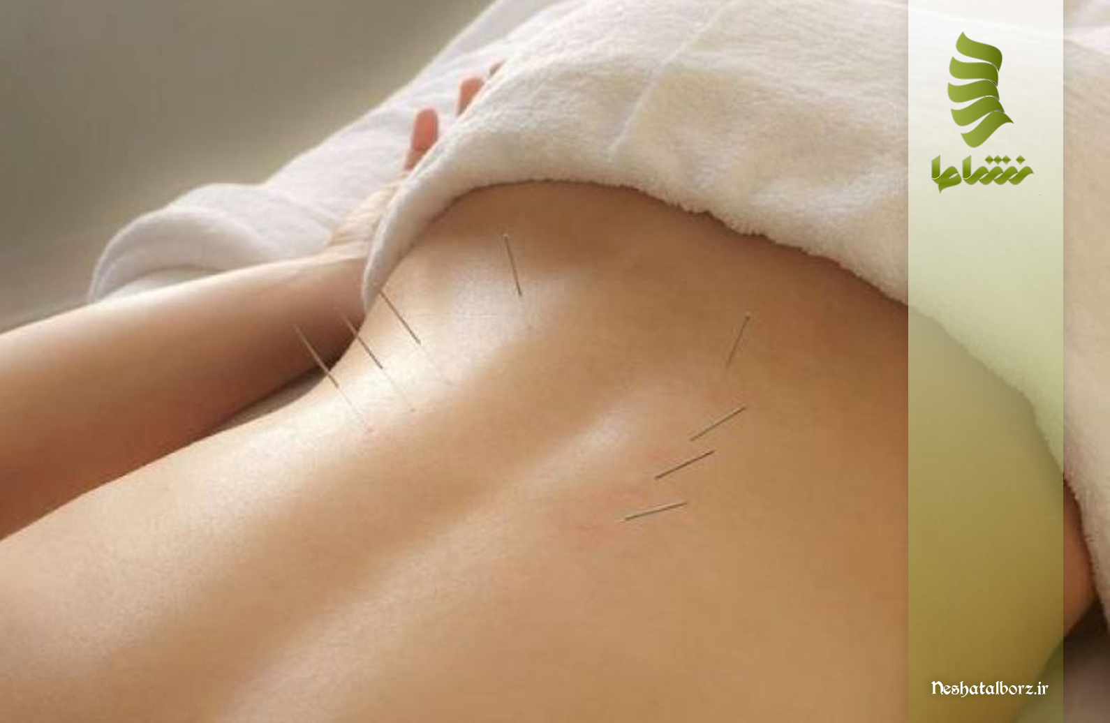 تاثیر طب سوزنی بر درد سیاتیک