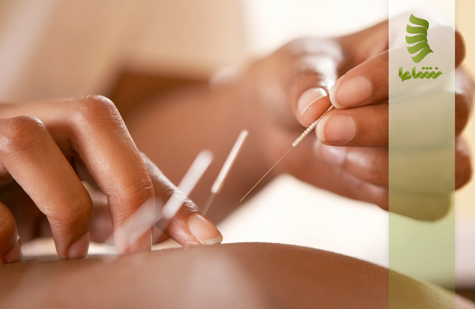 درمان درد سیاتیک با طب سوزنی