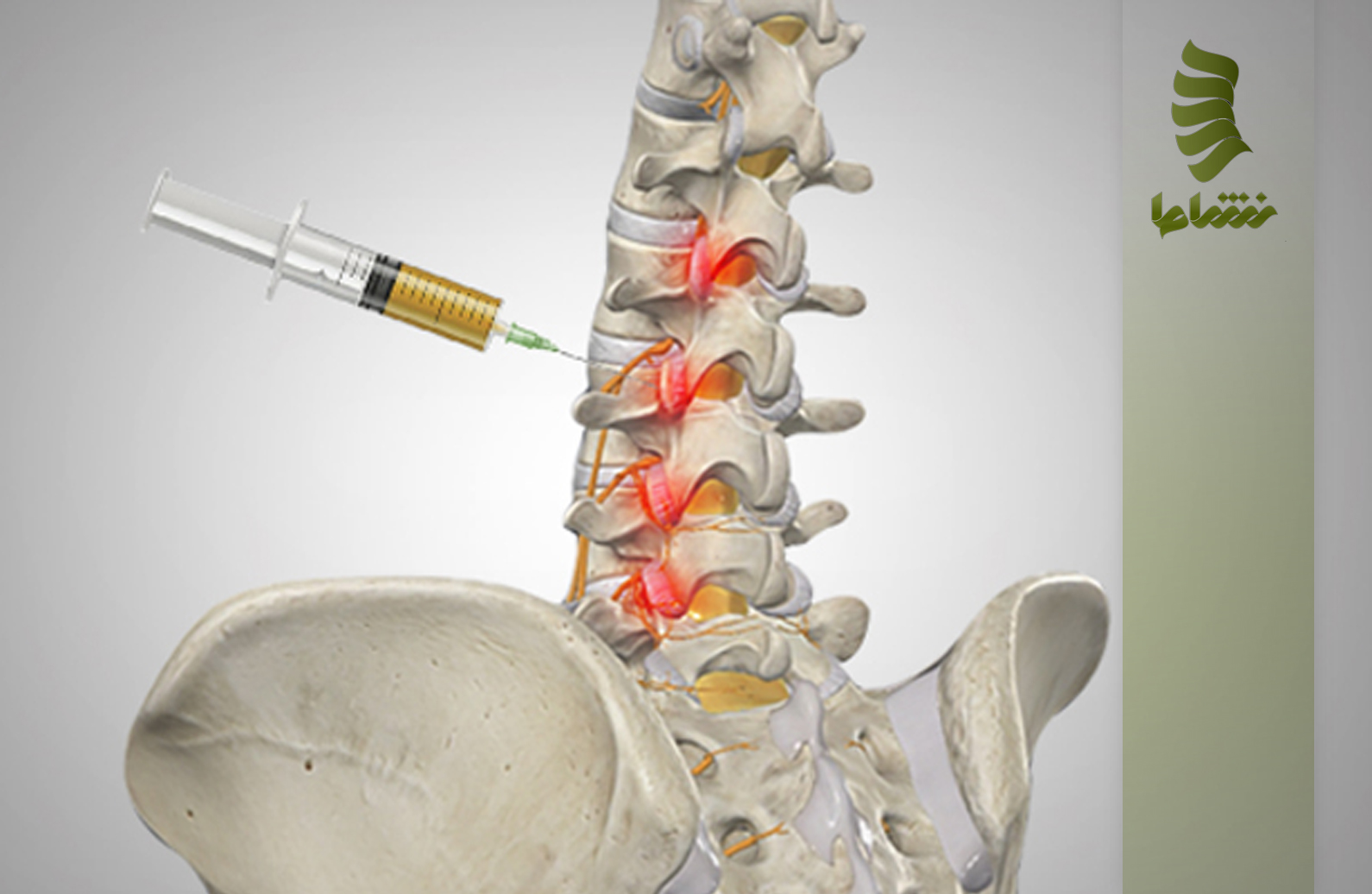 تزریق پی آر پی به دیسک کمر