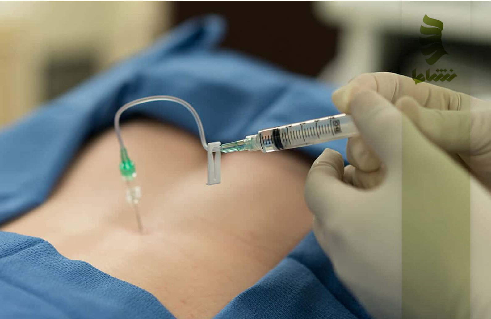 پی آر پی برای کمردرد