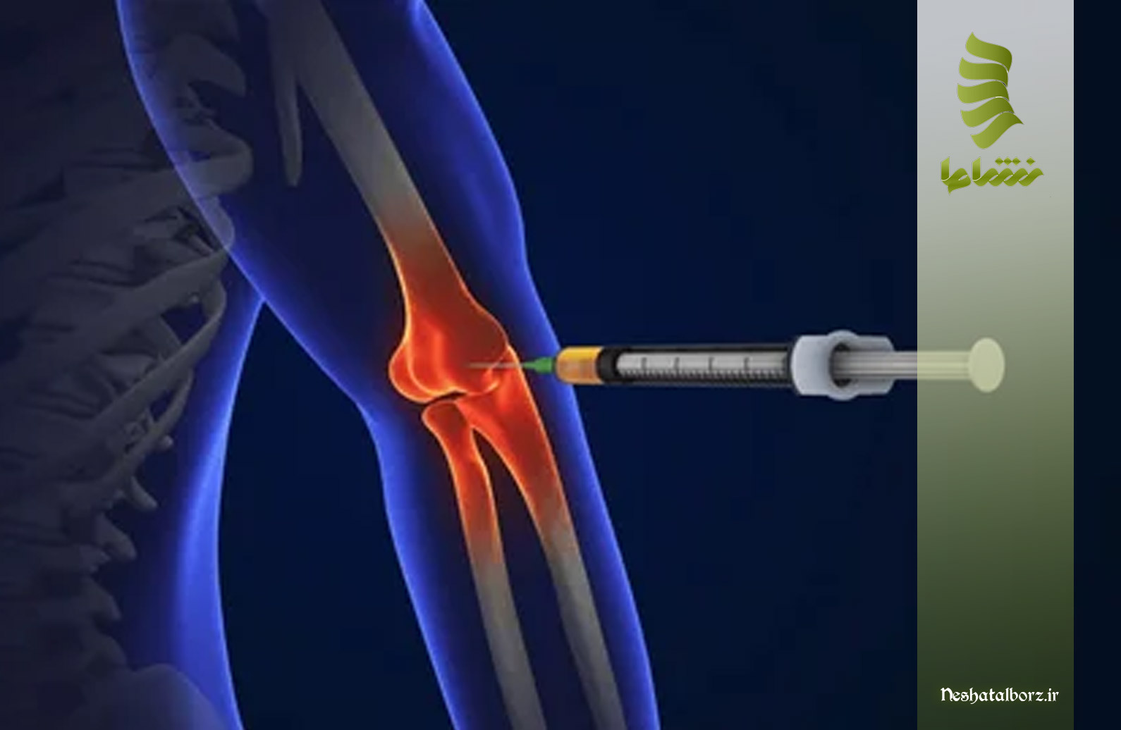 درمان درد آرنج با پی آر پی