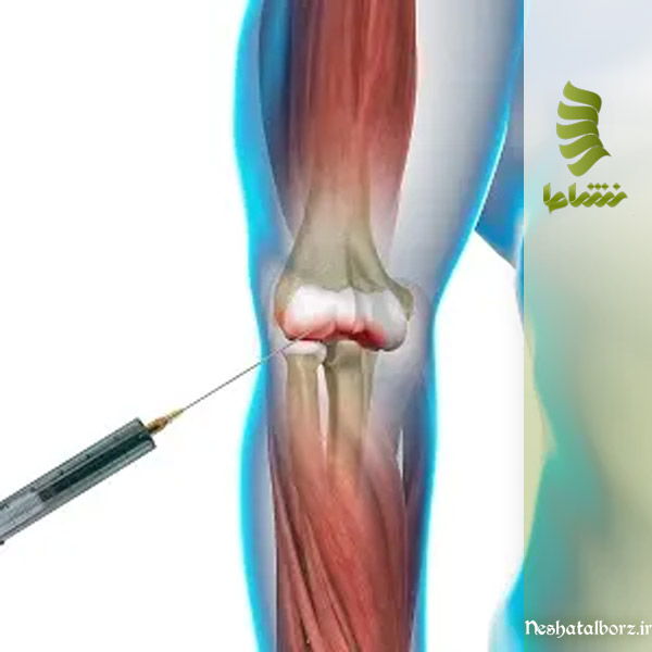 تزریق پی آرپی برای درمان آرنج تنیس بازان در فردیس