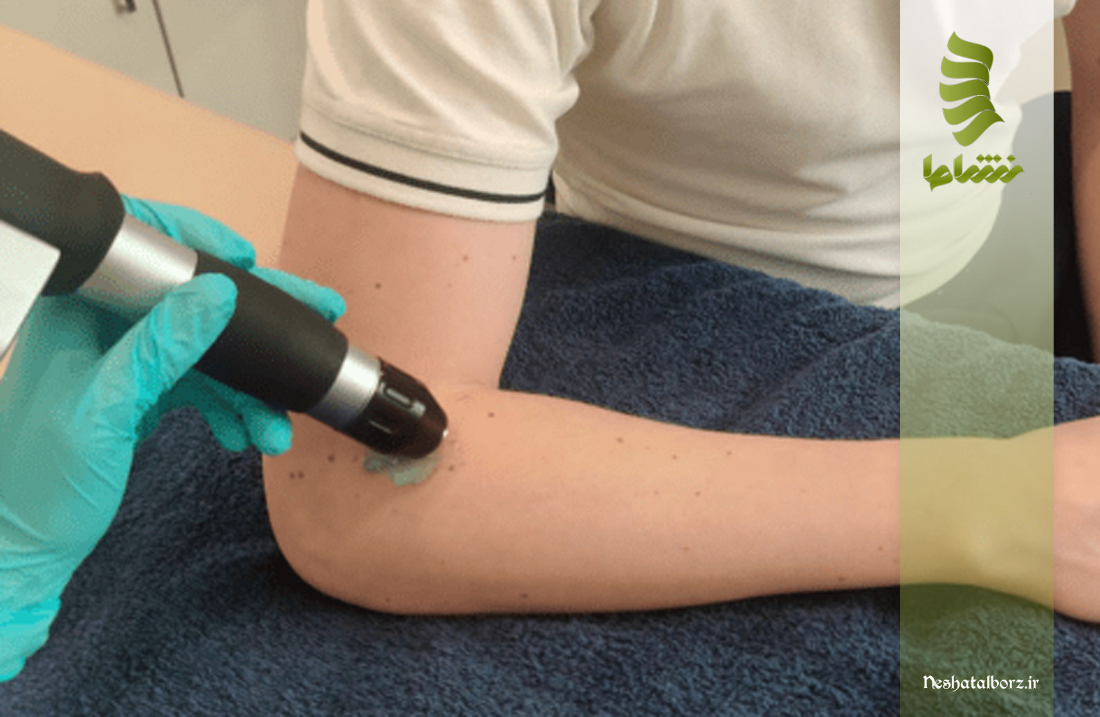 مراحل شاک ویو تراپی برای درمان آرنج تنیس بازان