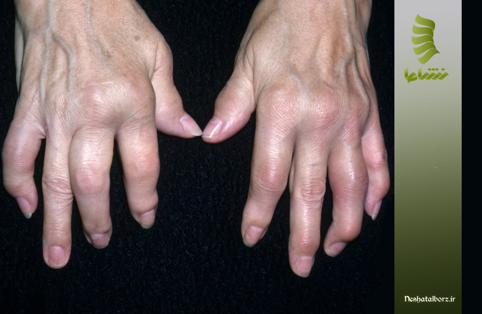 علائم سندرم آرتریت پسوریاتیک