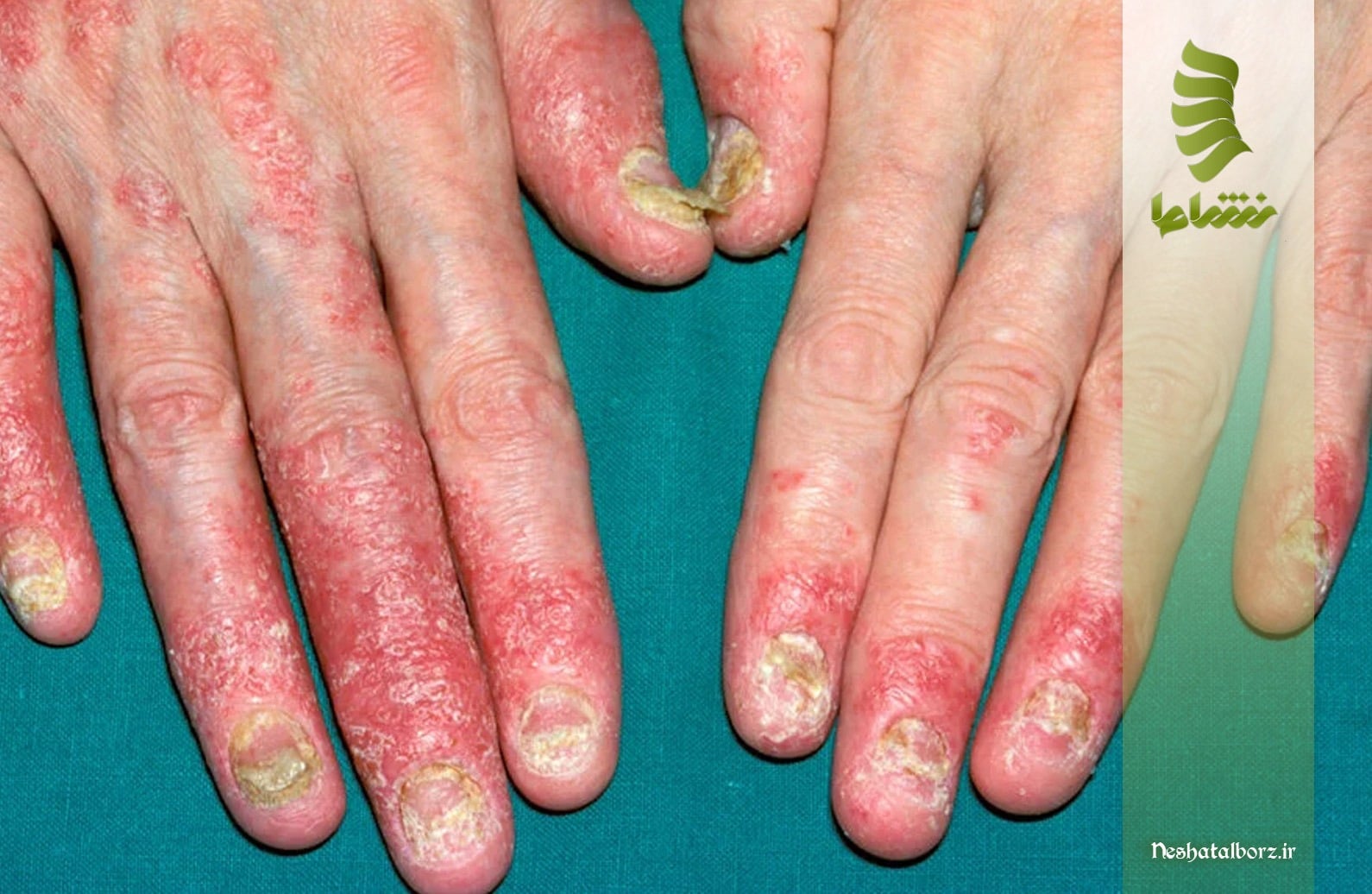 درمان سندرم آرتریت پسوریاتیک