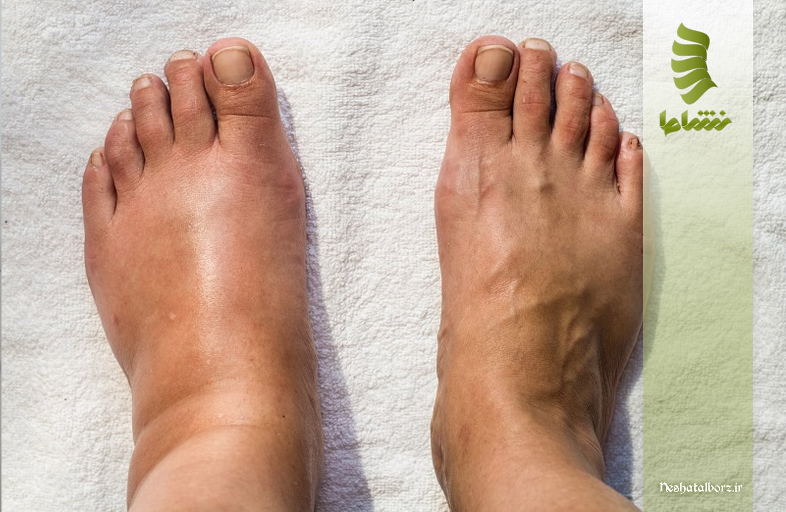 ورم پا ناشی از دیسک کمر