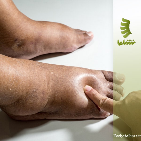 علت و درمان ورم ناشی از دیسک کمر