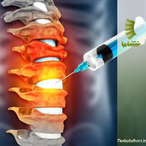تزریق دیسکوژل چگونه انجام می‌شود؟