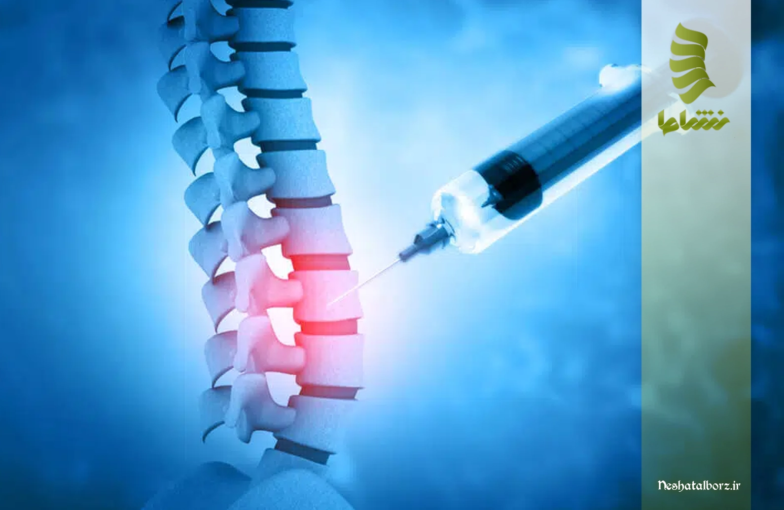 تزریق دیسکوژل به دیسک کمر
