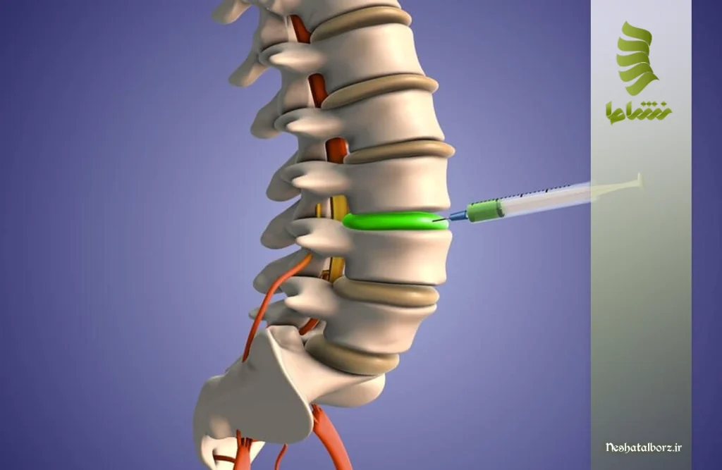 چه زمانی بعد از تزریق دیسکوژل به پزشک مراجعه کنیم؟