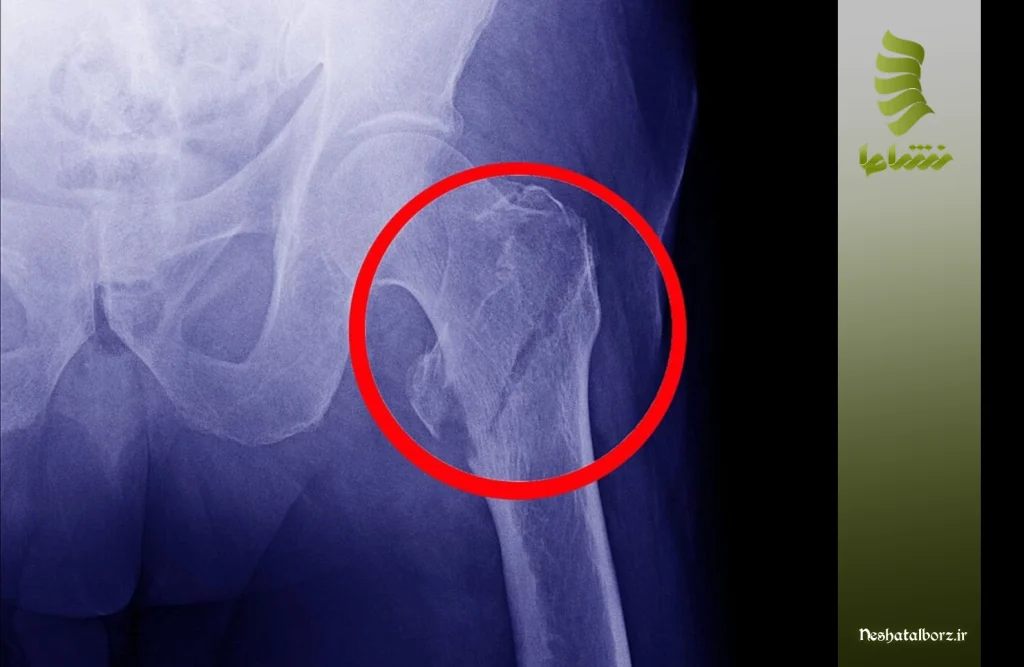 علائم شکستگی لگن