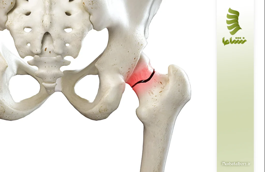 درمان شکستگی لگن در کرج