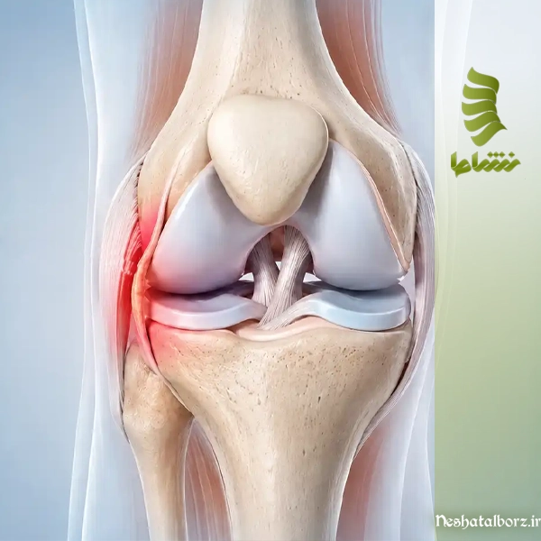 سندرم پلیکا چیست، درمان سندرم پلیکا با فیزیوتراپی